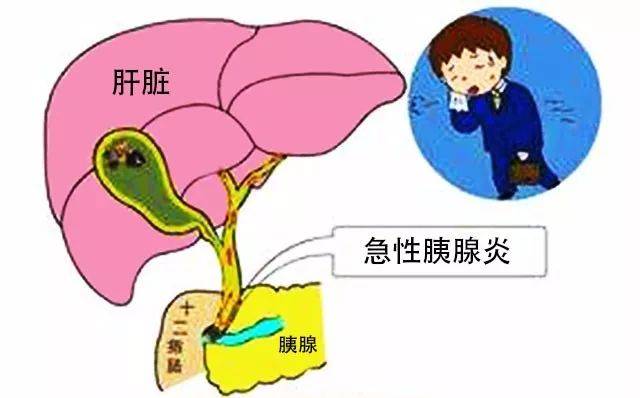 小心“沉默器官”的致命反击！急性胰腺炎：隐匿的健康杀手【成都肝胆结石医院】(图2)