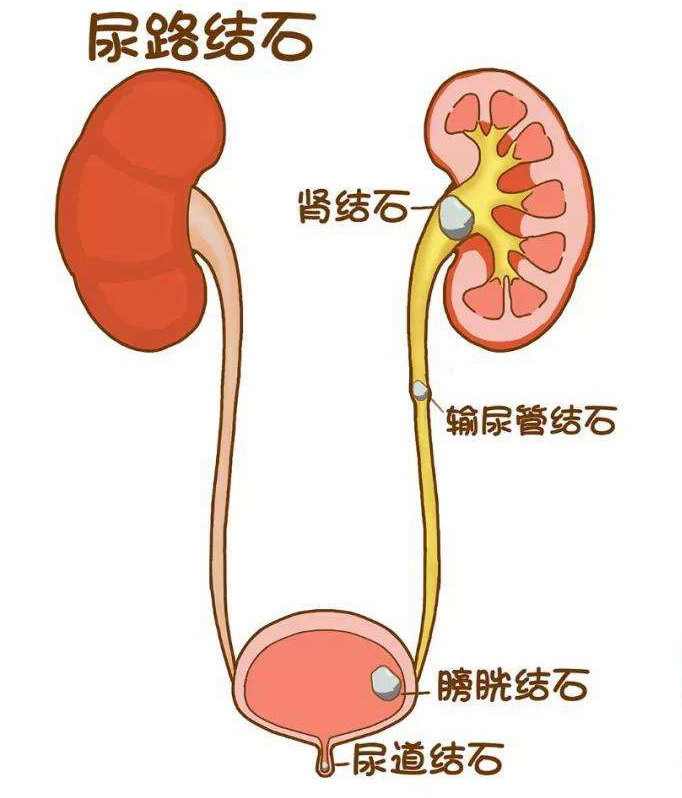 长期憋尿会诱发肾结石吗？四川肾结石专科医院解答：一文为你理清二者关系！(图3)